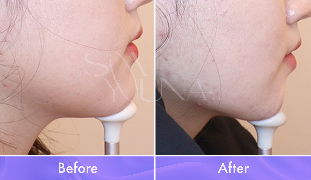 Protruding Chin CAT before and after photo