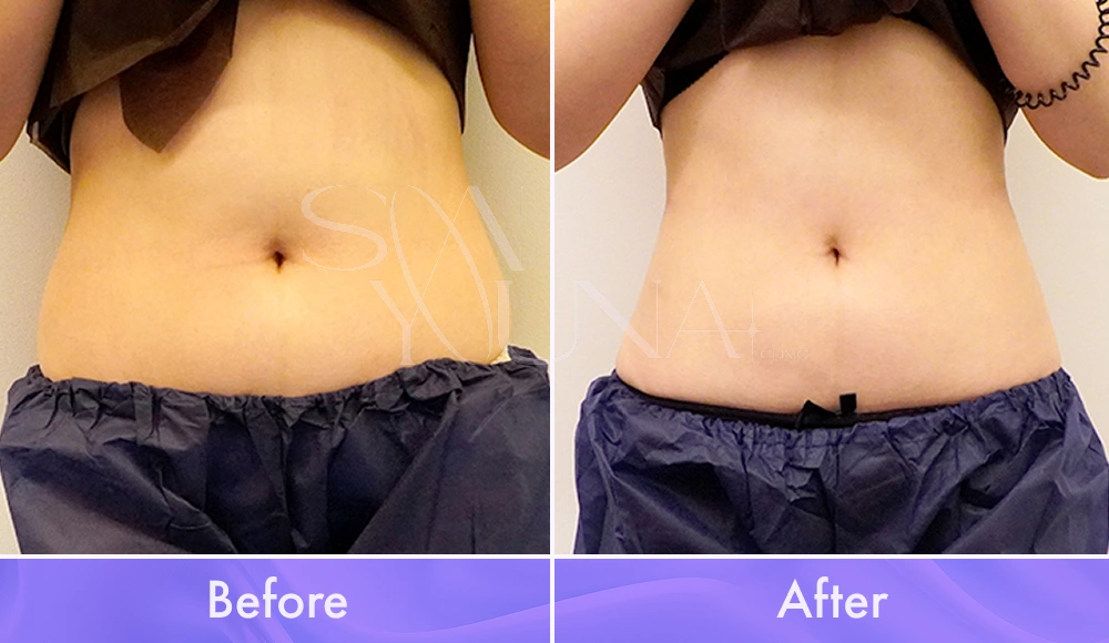 Magic Abdomen CAT before and after photo
