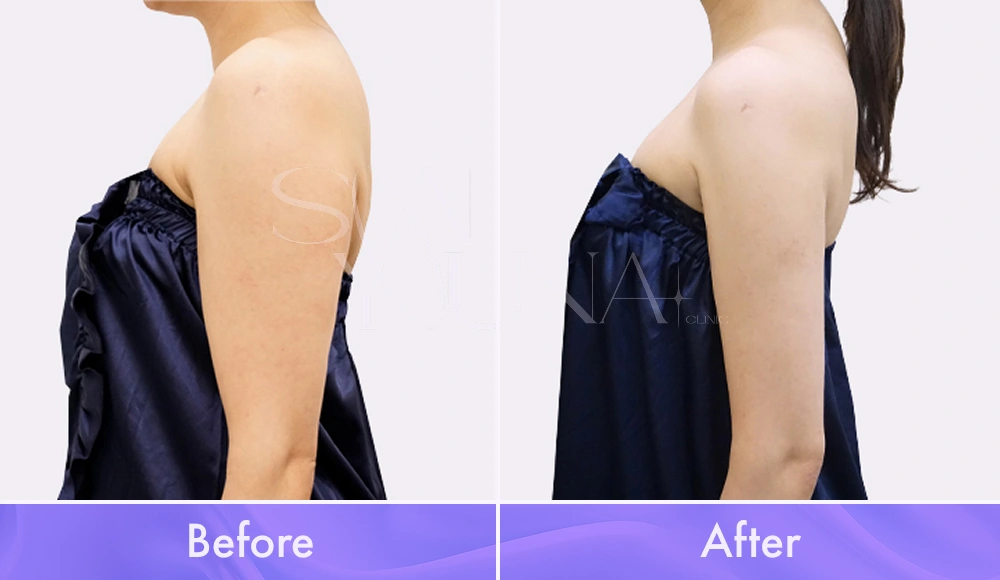 Magic Arm CAT before and after photo