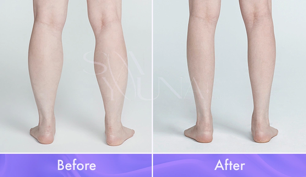Magic Calf CAT before and after photo