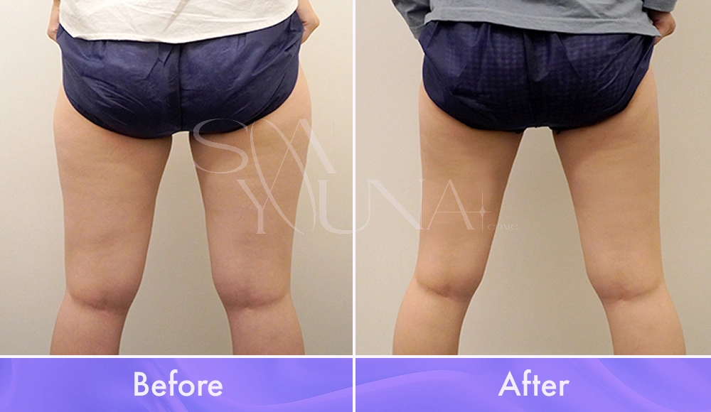 Magic Thigh CAT before and after photo