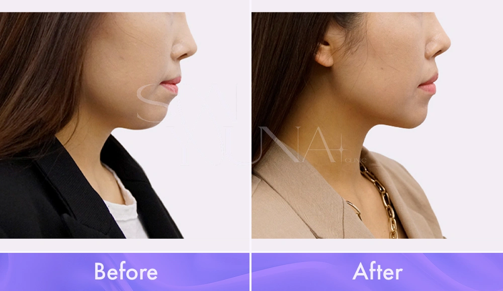 Magic V CAT and Cheek CAT before and after photo