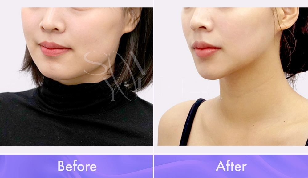 Magic V CAT and Cheek CAT before and after photo