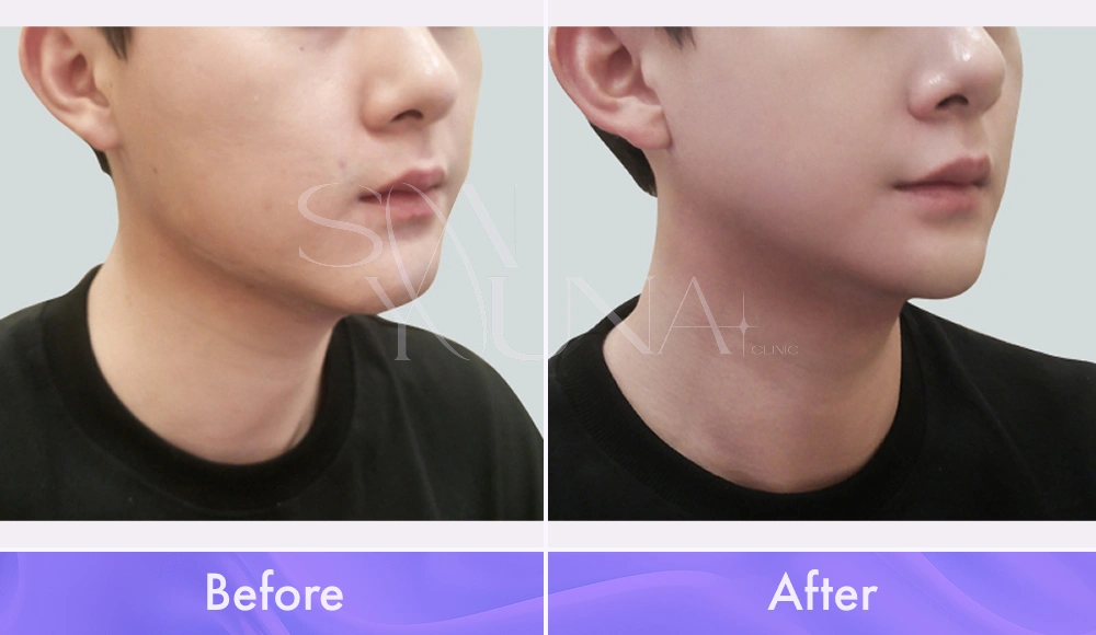 Magic V CAT and Cheek CAT before and after photo