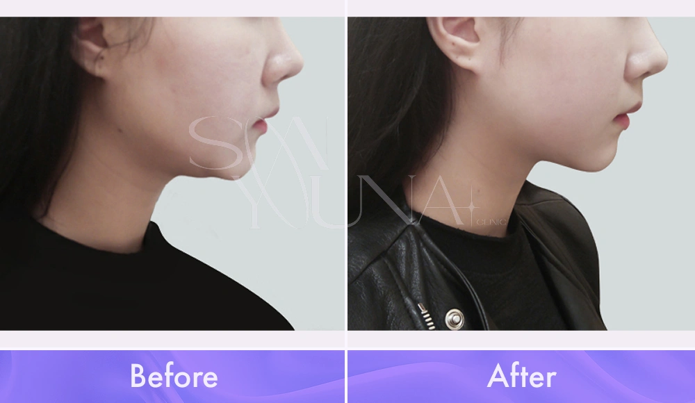 Magic V CAT and Cheek CAT before and after photo