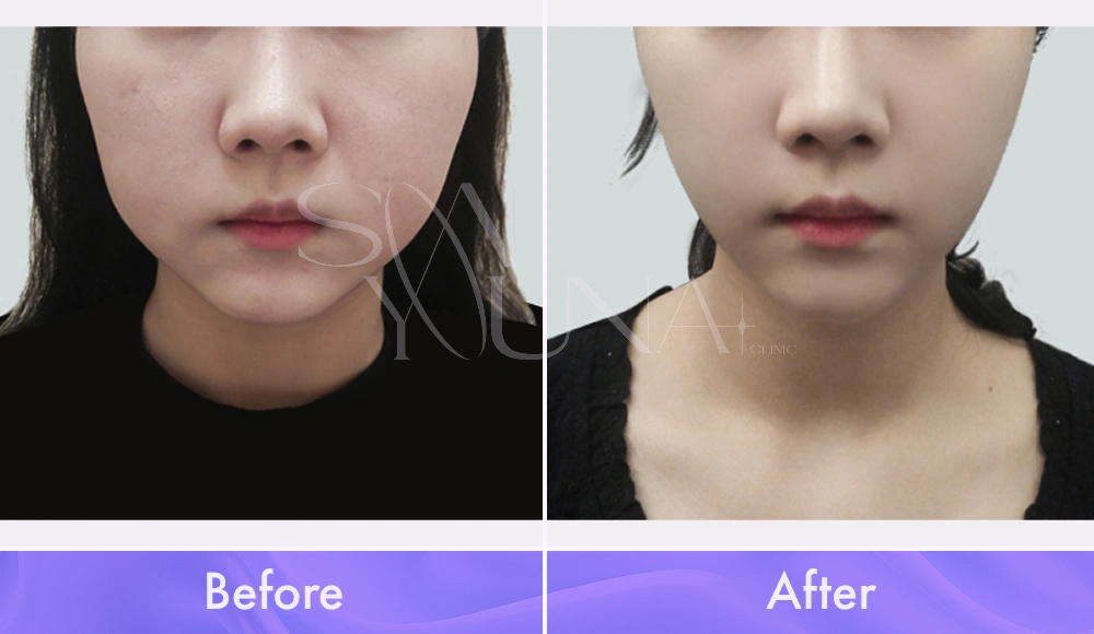 Magic V CAT and Cheek CAT before and after photo