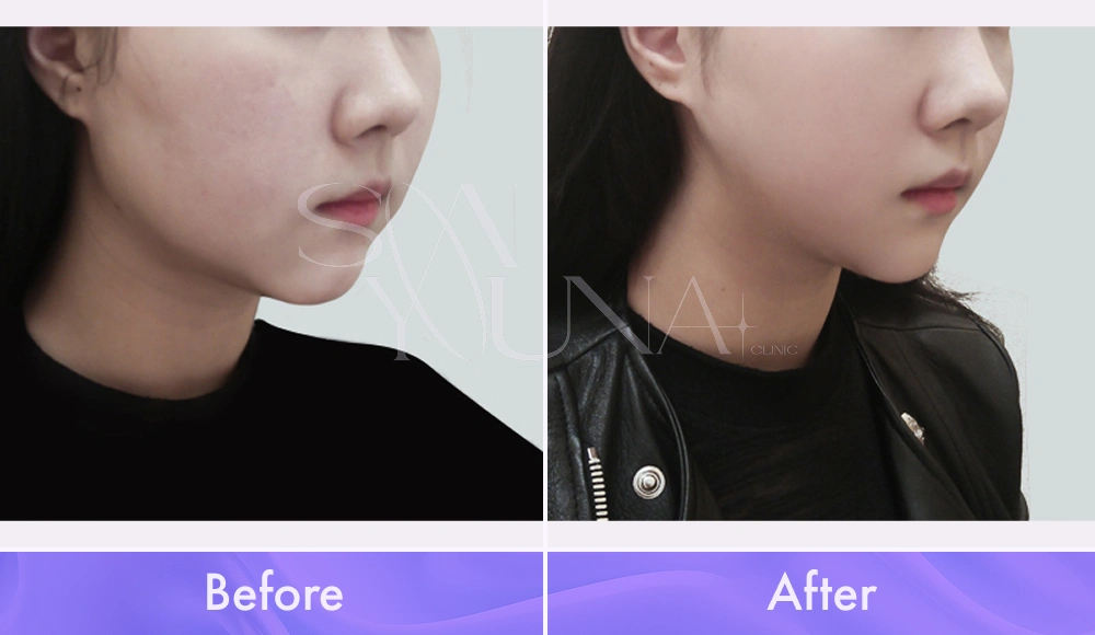 Magic V CAT and Cheek CAT before and after photo