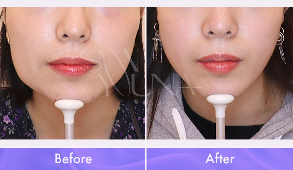 Magic V CAT and Cheek CAT before and after photo